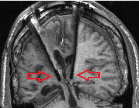 Deep Brain Stimulation electrodes in the thalamus